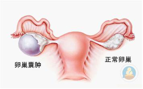 卵巢囊腫，抱腿壓涌泉穴，給你愛心呵護(hù)