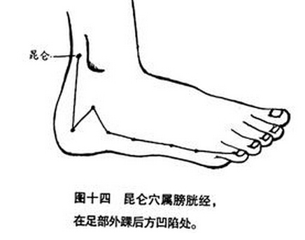 中醫(yī)針刺昆侖穴可以治療落枕