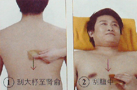 慢性支氣管炎—刮痧療法