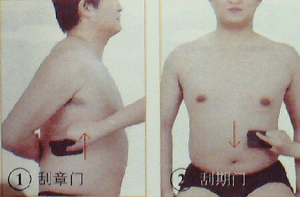 胃、十二指腸潰瘍—刮痧